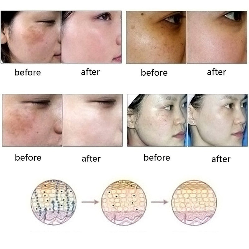 Dredge Meridian Skin Care Natural Pure Removal Acné Vergetures Élimination des cicatrices Huile essentielle
